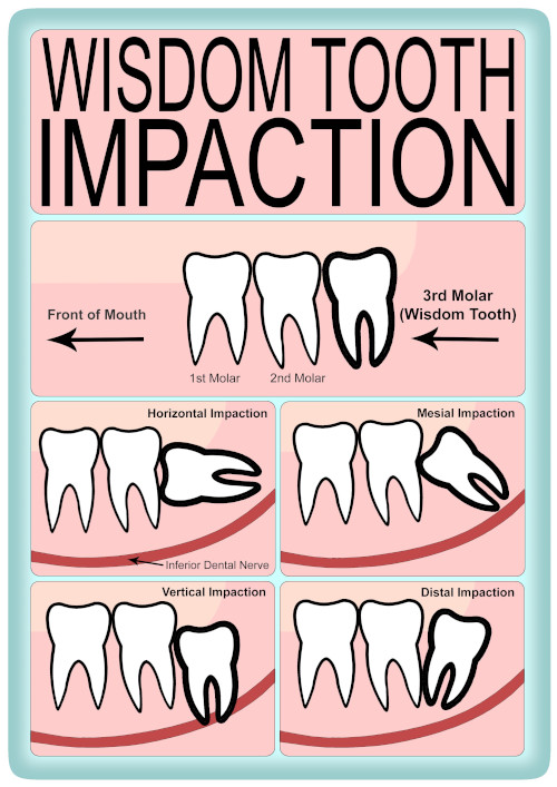 Removal Of Impacted Wisdom Teeth British Association Of Oral And