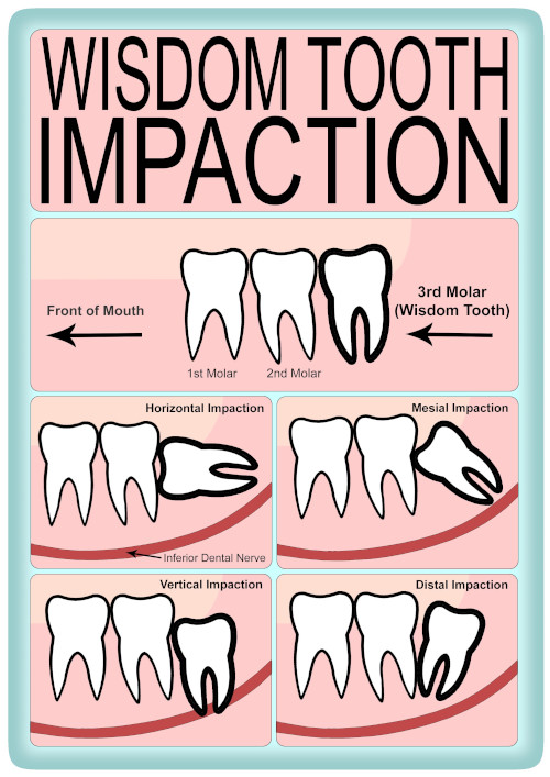 Partially Impacted Wisdom Teeth